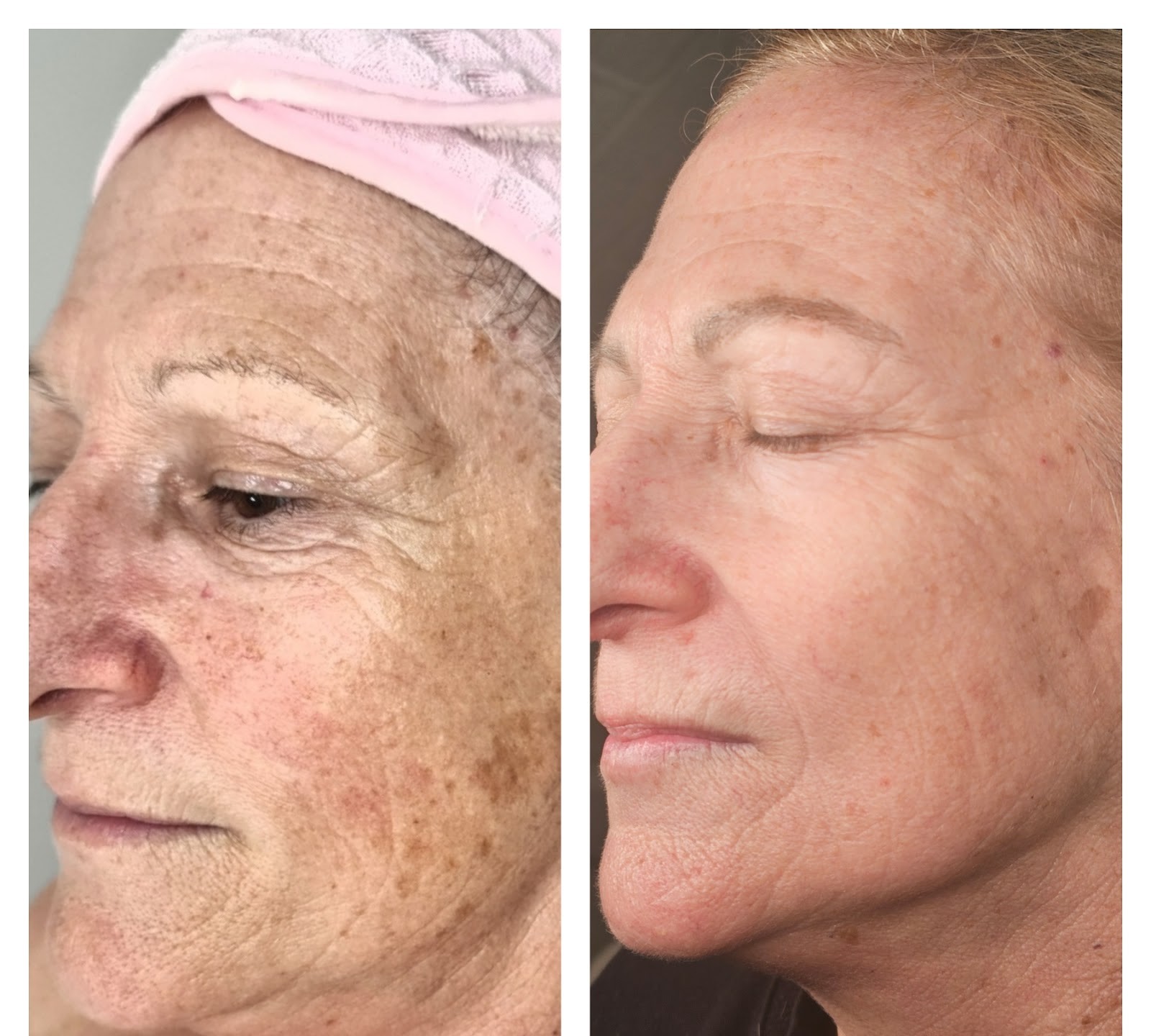 Before and after photos of a client’s skin